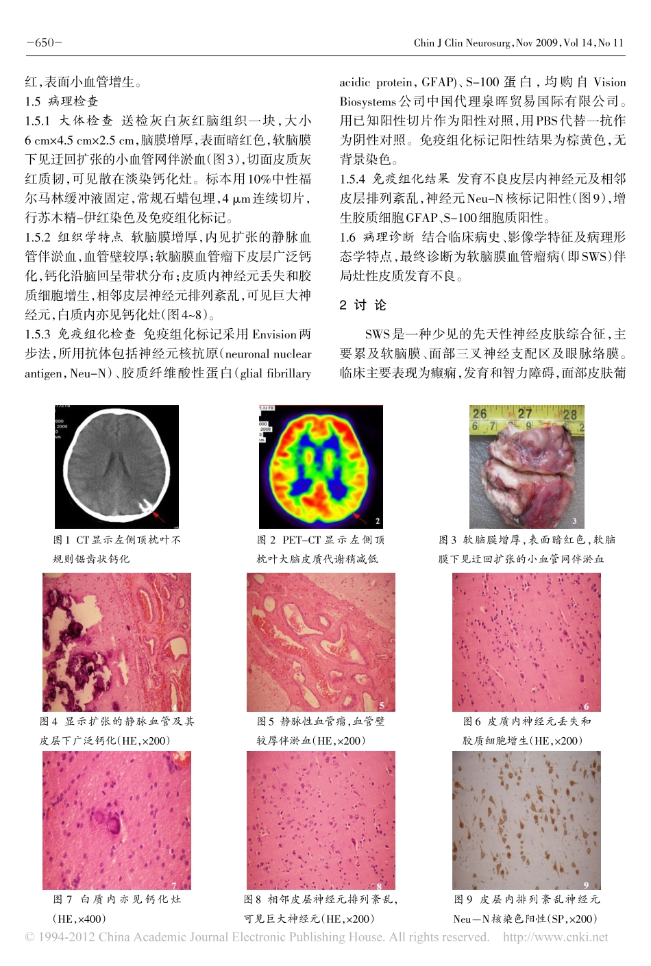 Sturge_Weber综合征伴皮层发育不良1例并文献复习_王蔚_第2页