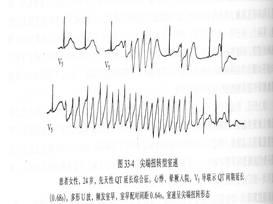 QT间期延长综合征_第3页