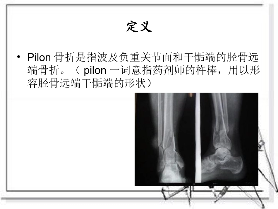 pilon骨折汇编_第2页