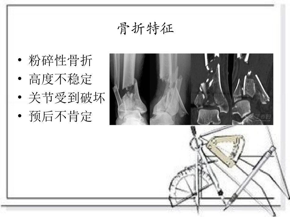 pilon骨折_第3页