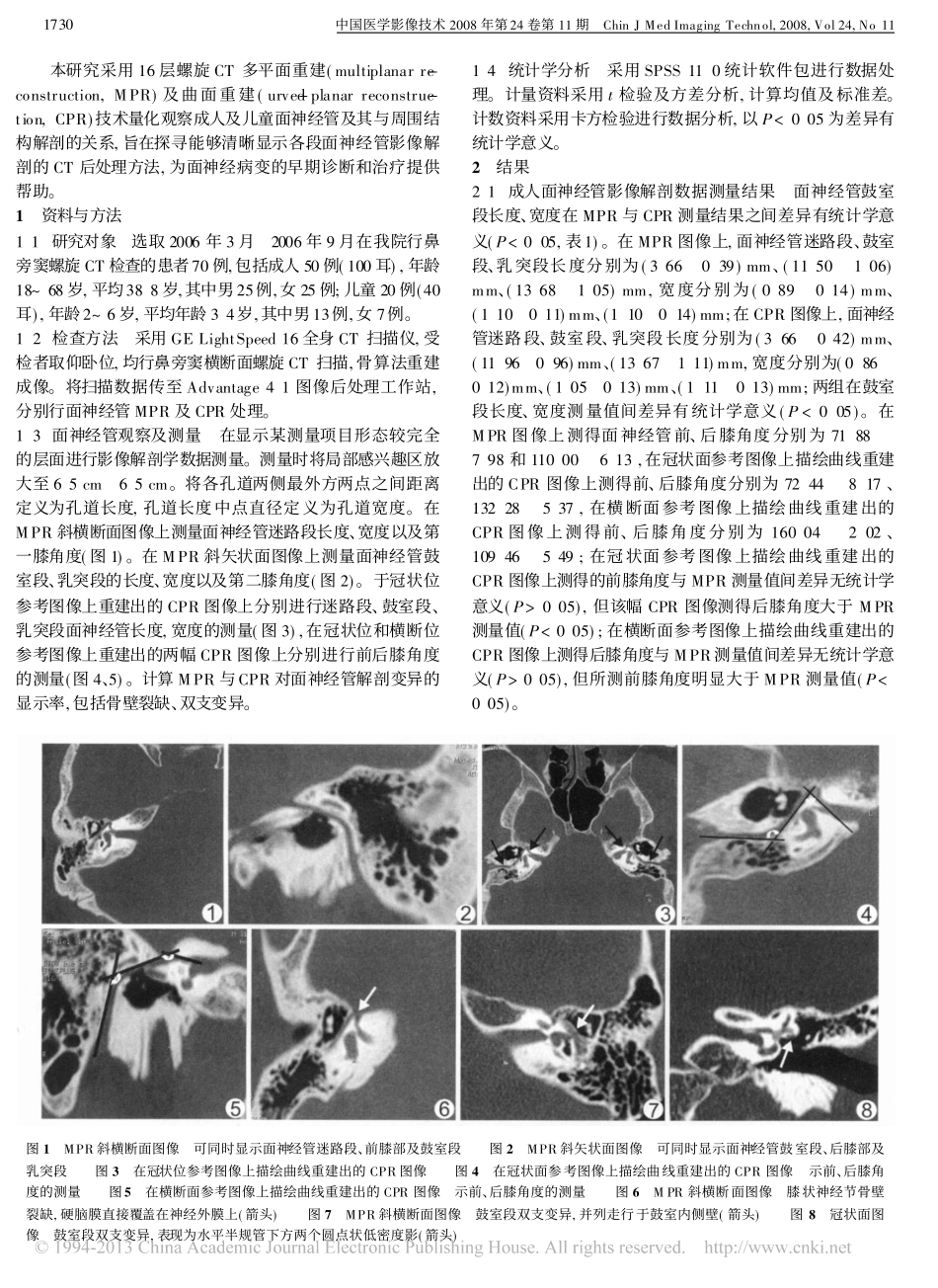 MSCT测量面神经管_第2页
