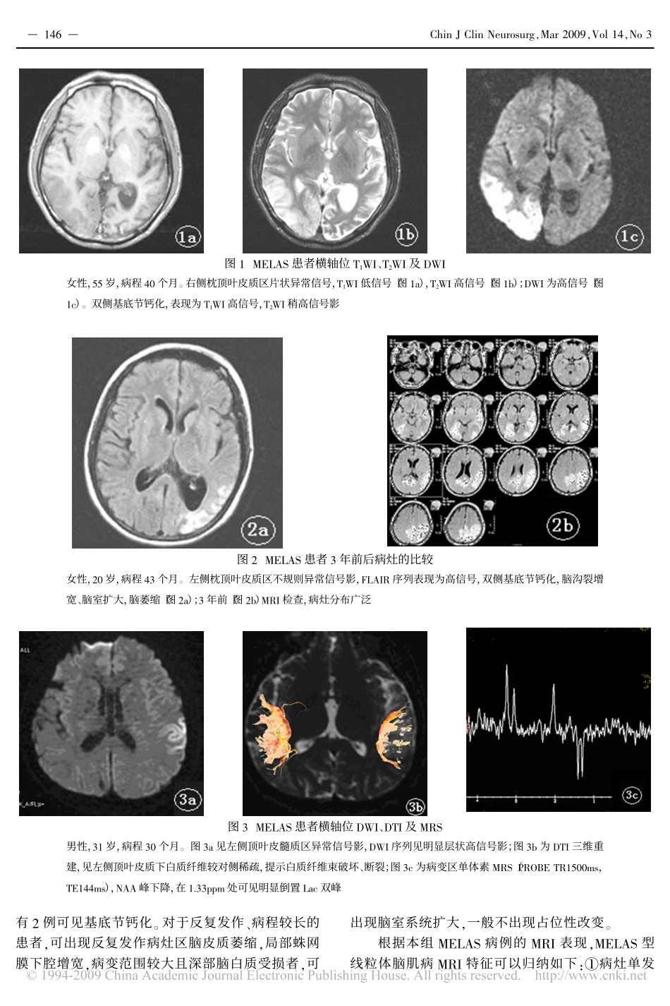 MELAS型线粒体脑肌病的MRI诊断[1]_第3页