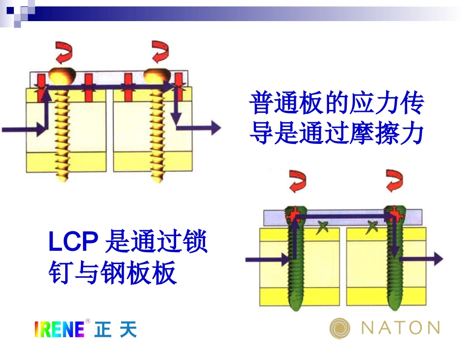 LCP系统接骨板的注意问题及常见问题(免金币)_第3页