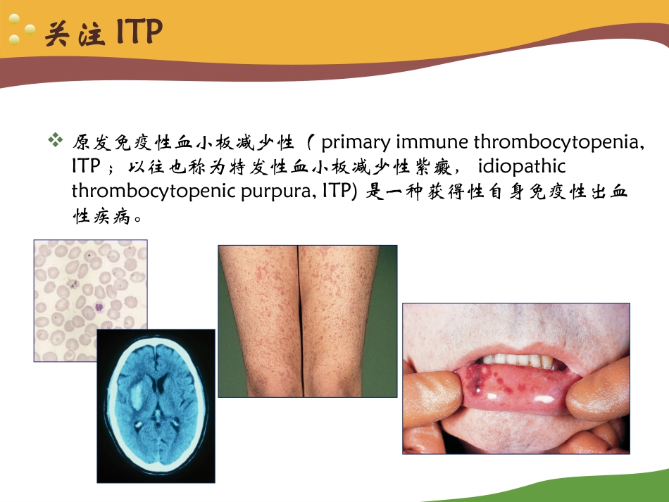 ITP诊治中国专家共识 (1)_第3页