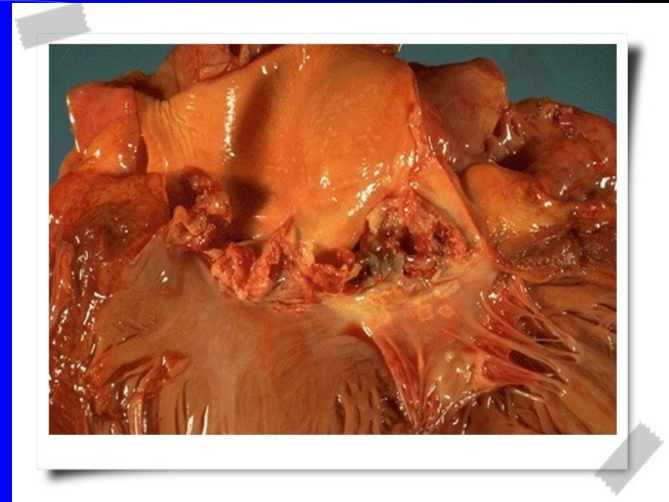 IE感染性心内膜炎_第3页