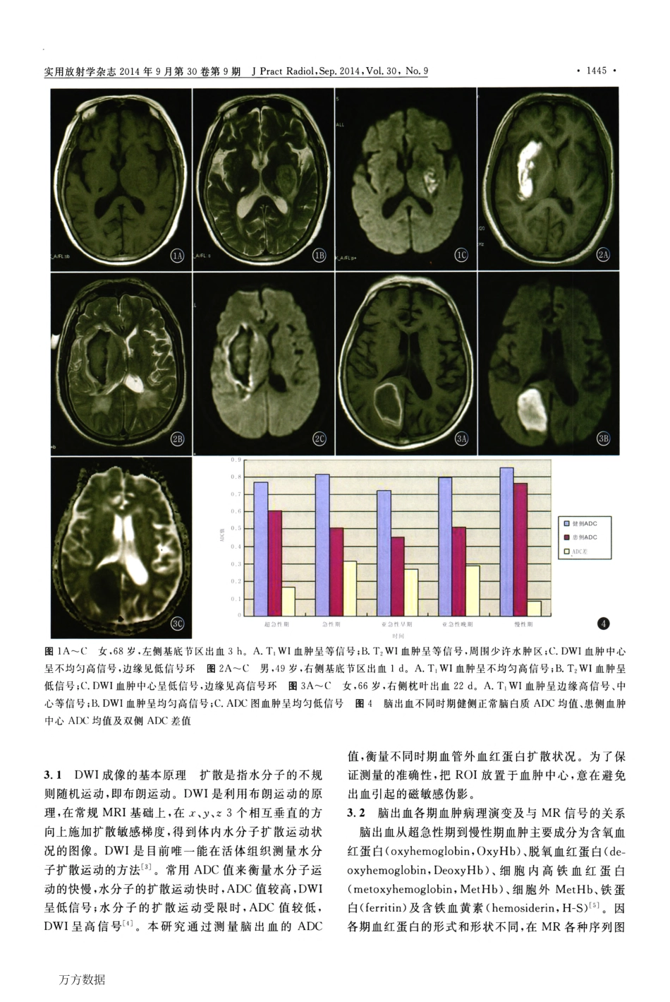 DWI对脑出血的诊断及鉴别诊断_第3页