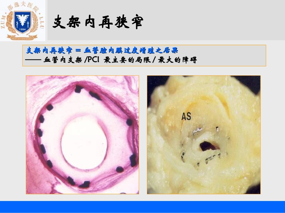 des支架内再狭窄的处理_孙勇_第2页