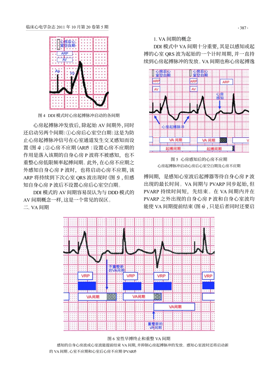 DDI起搏心电图_第3页