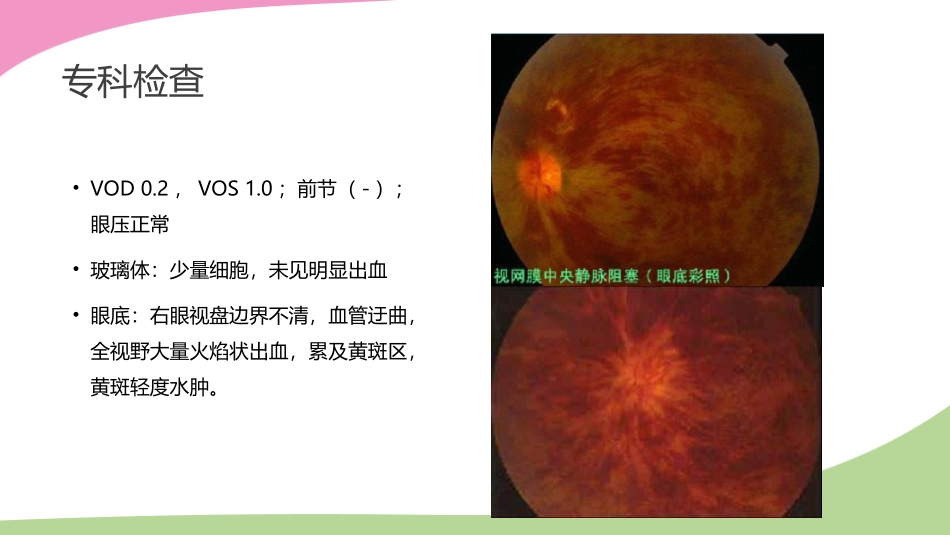 CRVO视网膜中央静脉阻塞病例分析_第3页