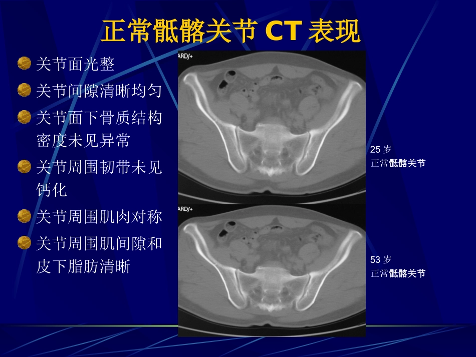 AS骶髂关节病变的CT诊断_第3页