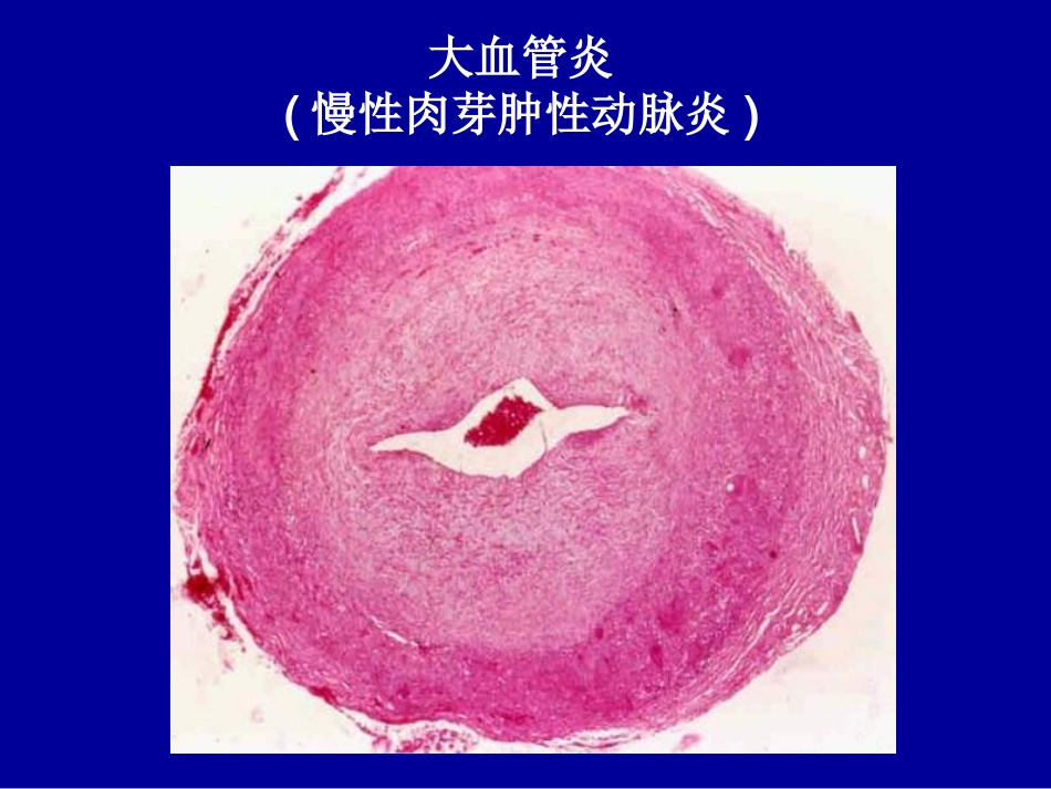 ANCA相关性小血管炎_第3页