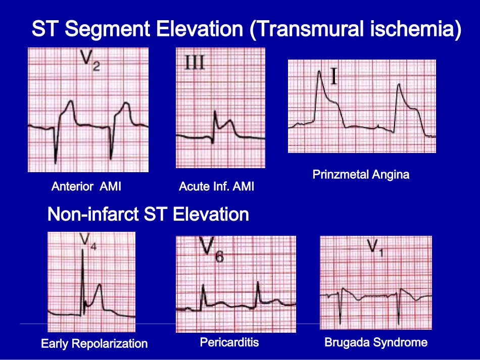 ACS治疗原则_第2页