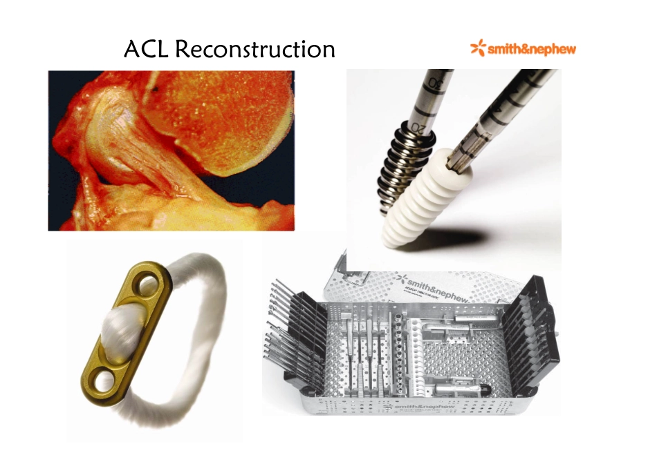 ACL 解剖单束重建_第2页