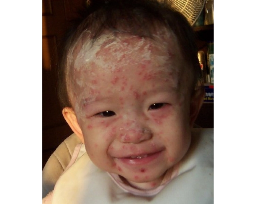 水痘的预防一(1)2013927_第2页