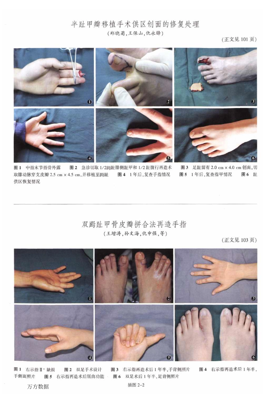 半趾甲瓣移植手术供区创面的修复处理_第3页
