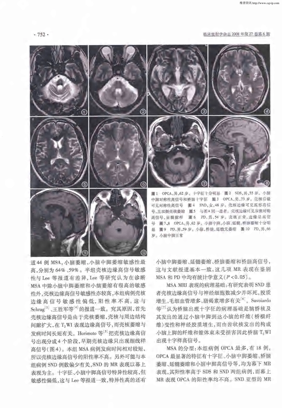 MRI在鉴别多系统萎缩与帕金森病中的价值_第3页