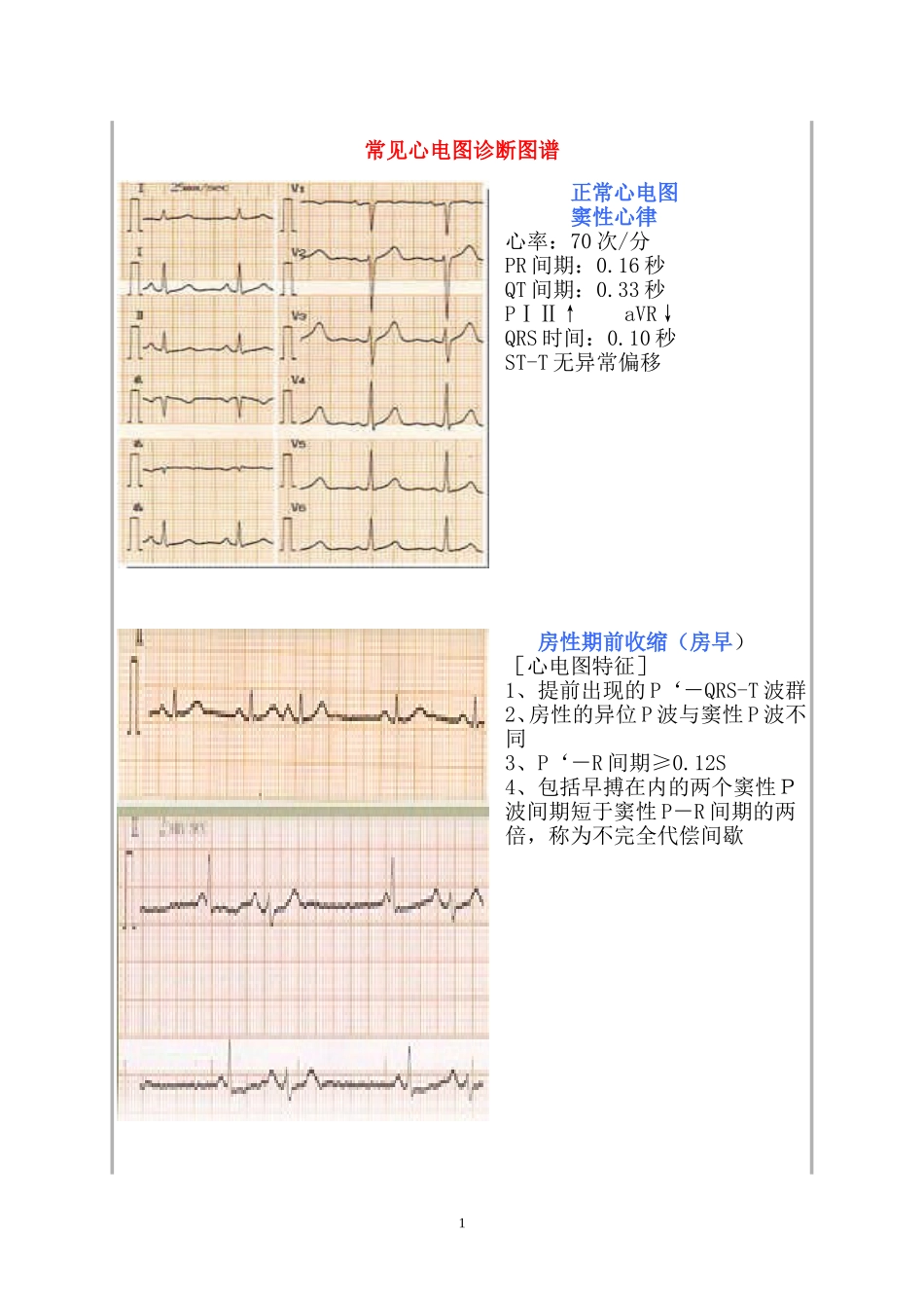 常见心电图诊断图谱_第1页