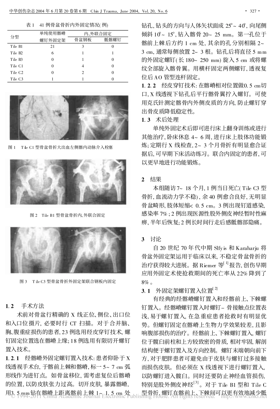 不稳定骨盆骨折的外固定架治疗_第2页
