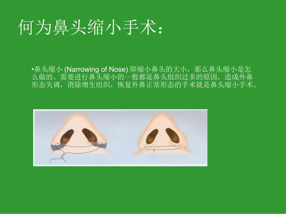 鼻头缩小手术_第2页