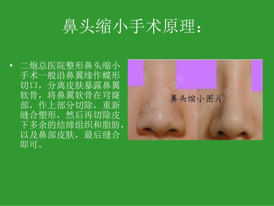 鼻头缩小手术_第3页
