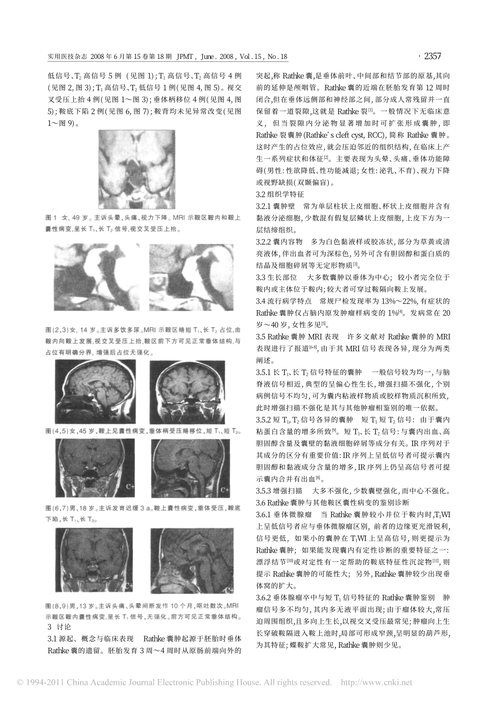 鞍区Rathke囊肿的MRI诊断_第2页