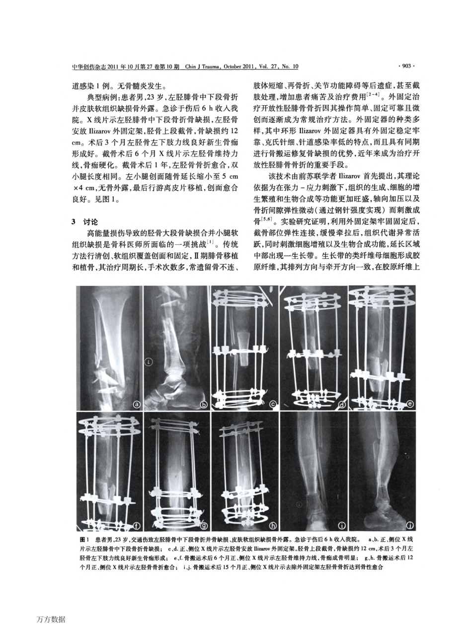 Ilizarov骨搬移技术治疗胫骨大段骨缺损合并软组织缺损_第3页