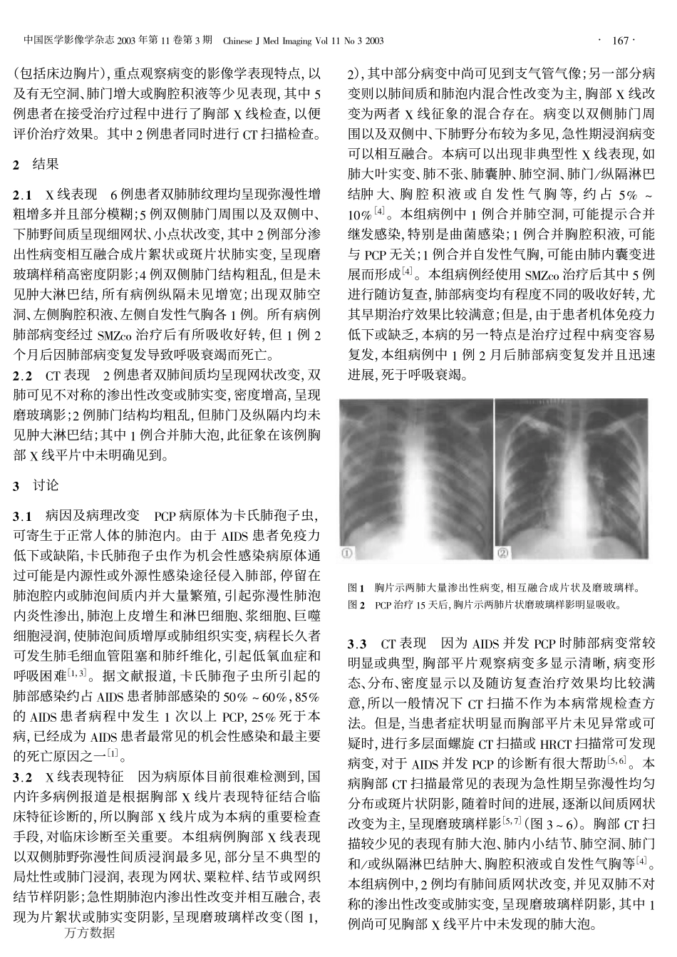艾滋病并发卡氏肺孢子虫肺炎的X线和CT诊断_第2页