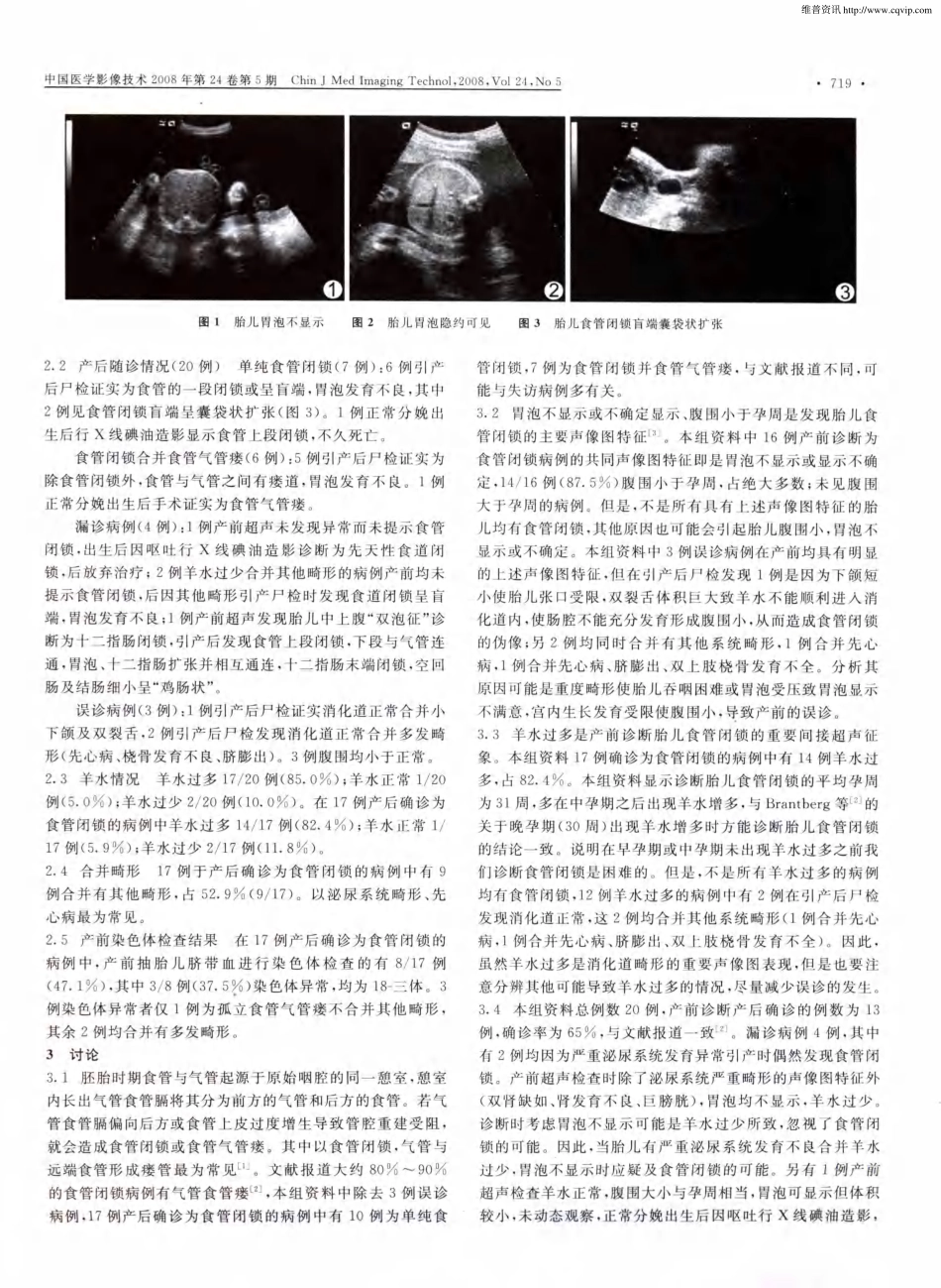 产前超声诊断胎儿食管闭锁的探讨_第2页