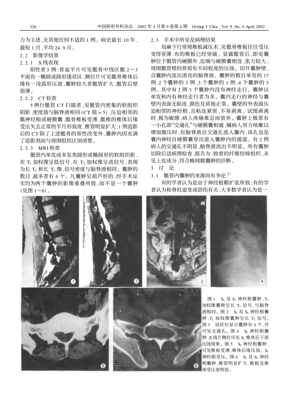 骶管内囊肿的诊断及其发生机制的探讨_第2页