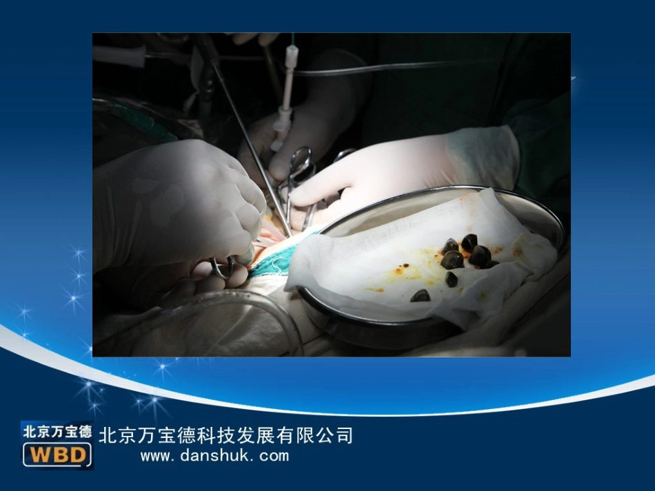 胆结石有没有急性慢性之分_第2页