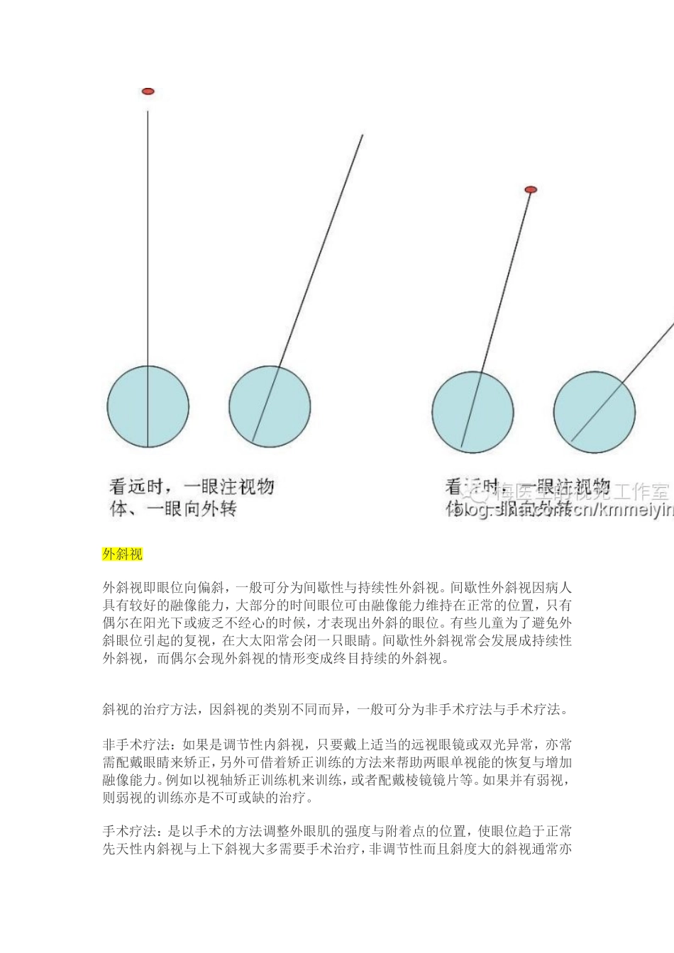 【视光】斜视、隐斜视与验光配镜的关系_第3页