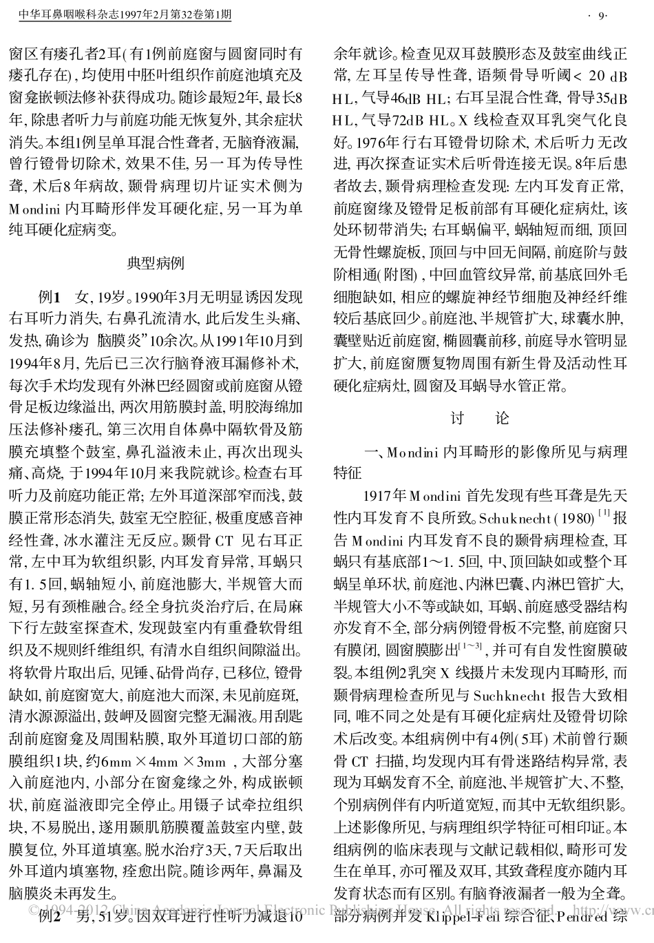 Mondini内耳畸形的诊断与治疗_第2页