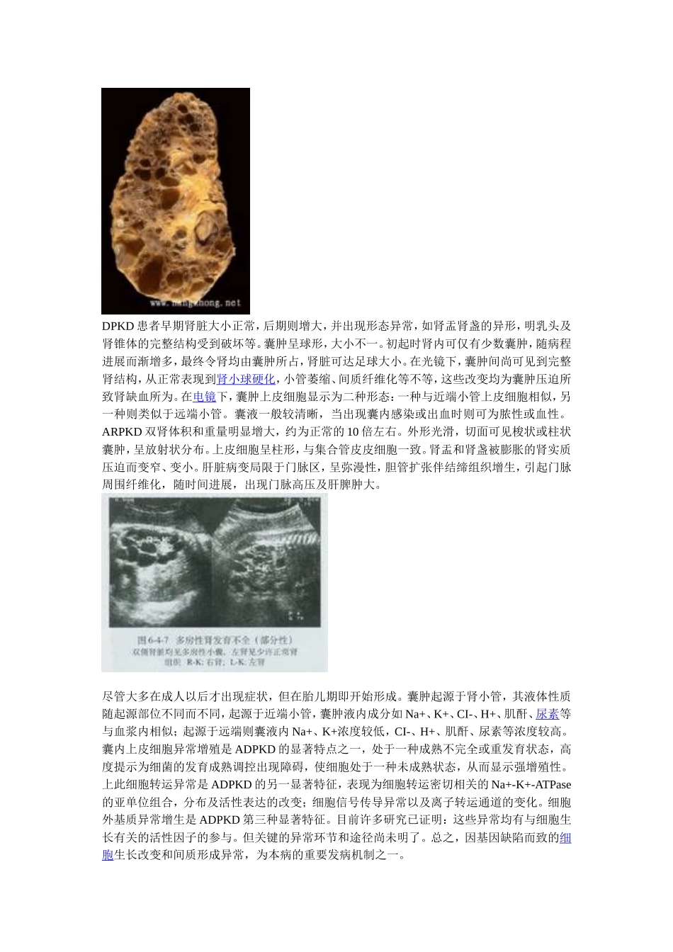 百度百科多囊肾_第3页