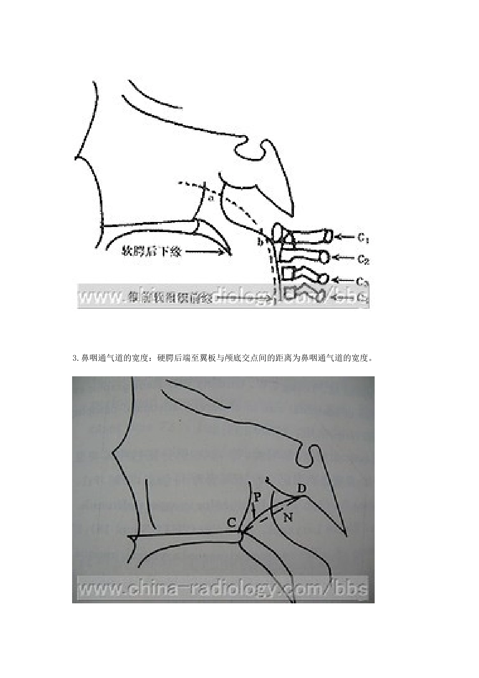 鼻咽增殖体肥大_第3页