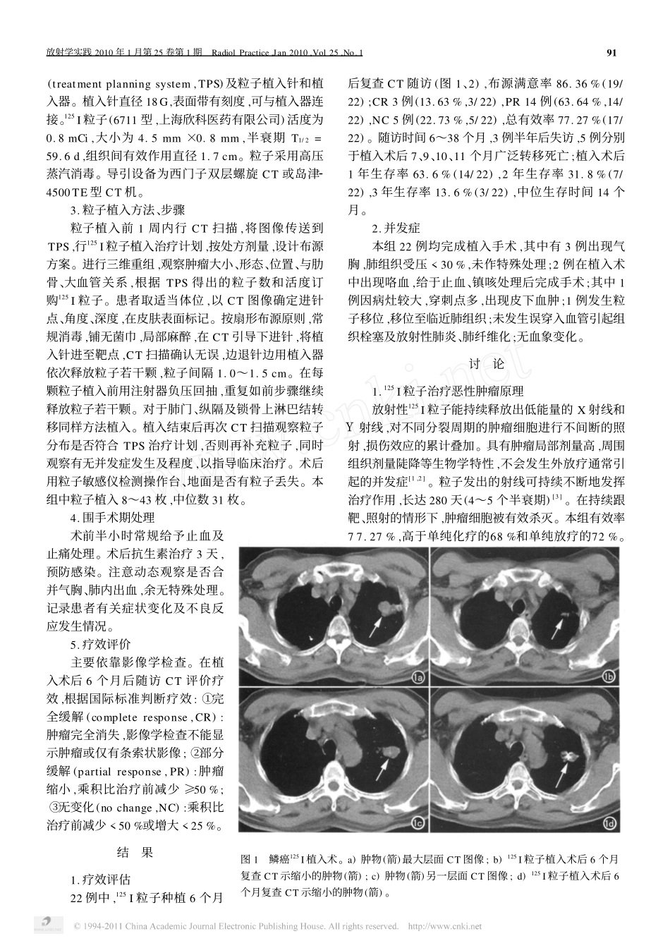 CT导引下_125_I粒子植入治疗周围型非小细胞肺癌_第2页