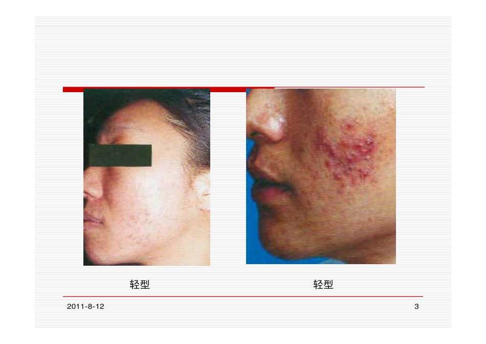 痤疮基础知识_第3页