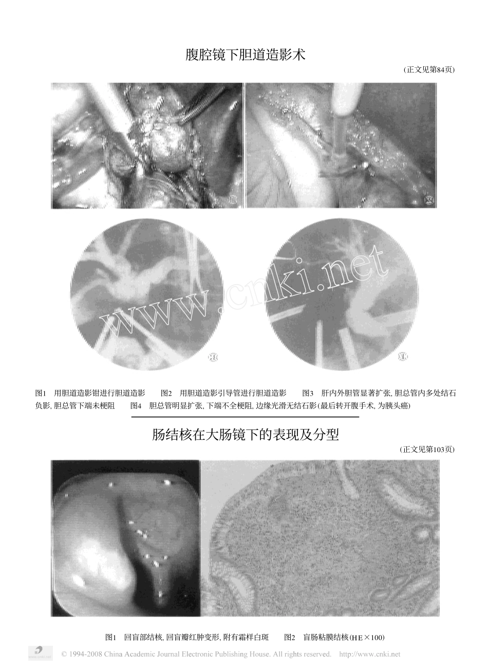 肠结核在大肠镜下的表现及分型_第3页