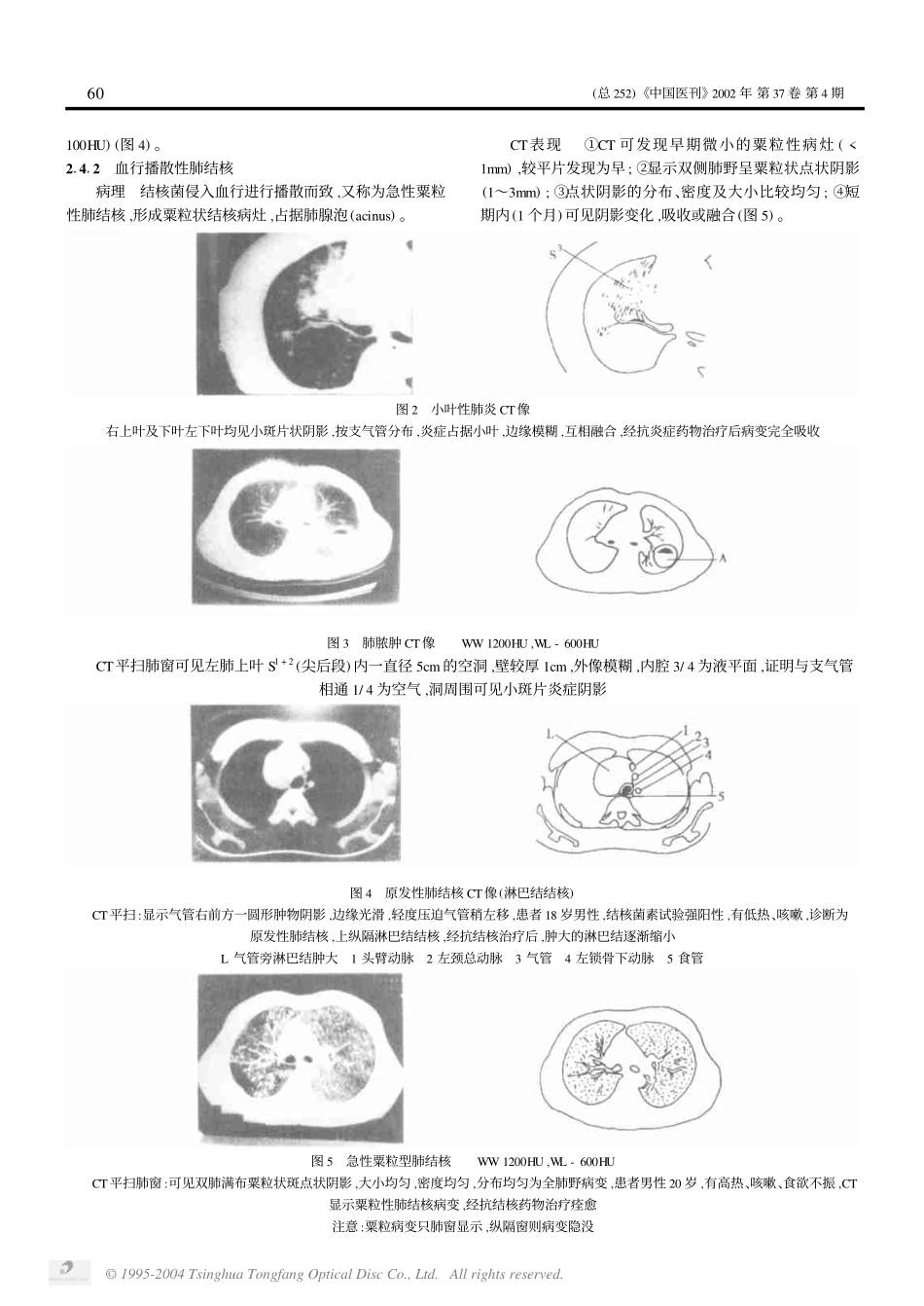 第10讲 胸部疾病的CT诊断1(一)_第2页