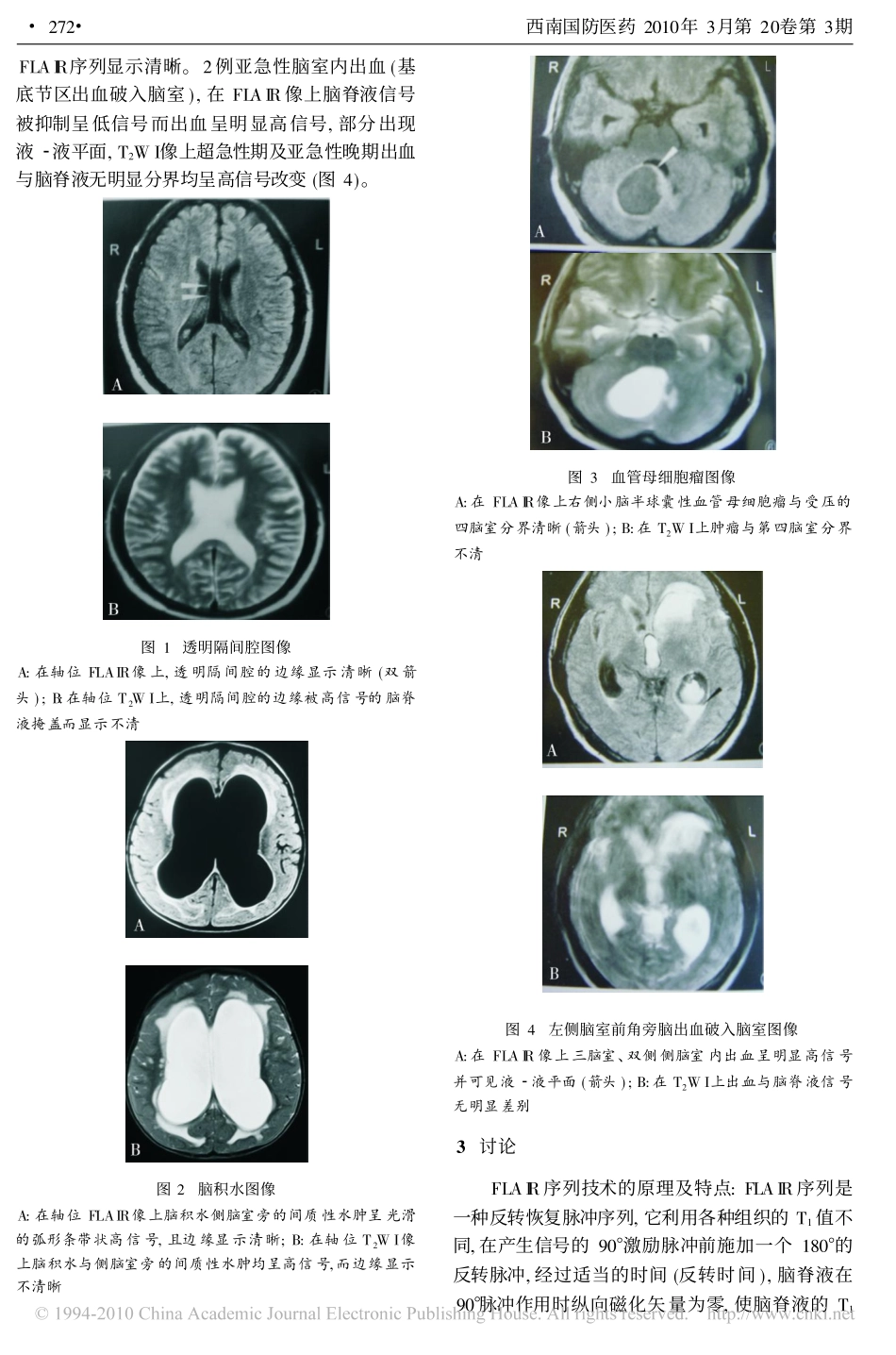 磁共振FLAIR序列在颅脑病变中的应用_第2页