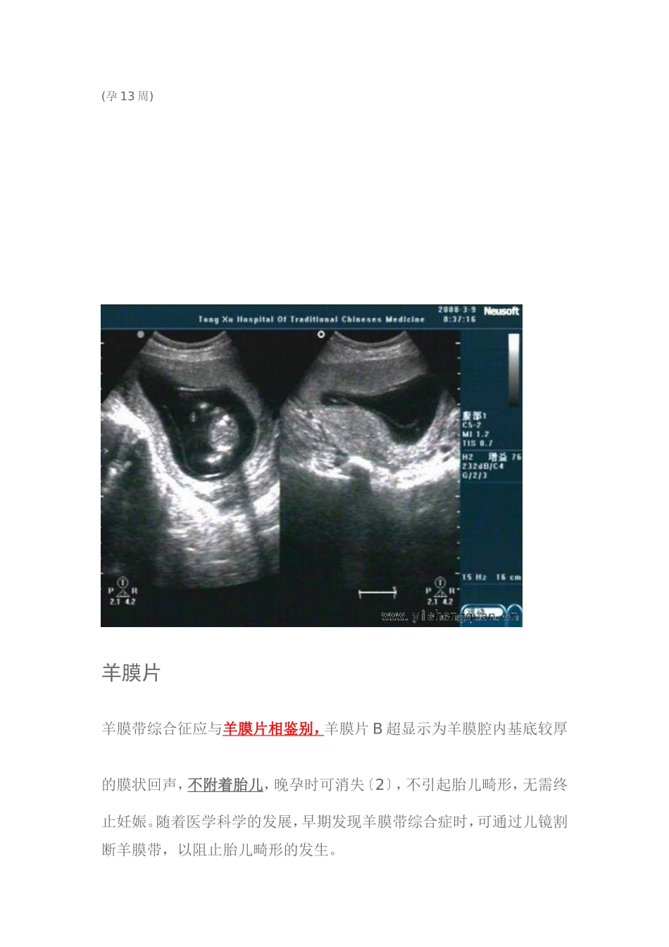 超声羊膜带 羊膜片_第2页