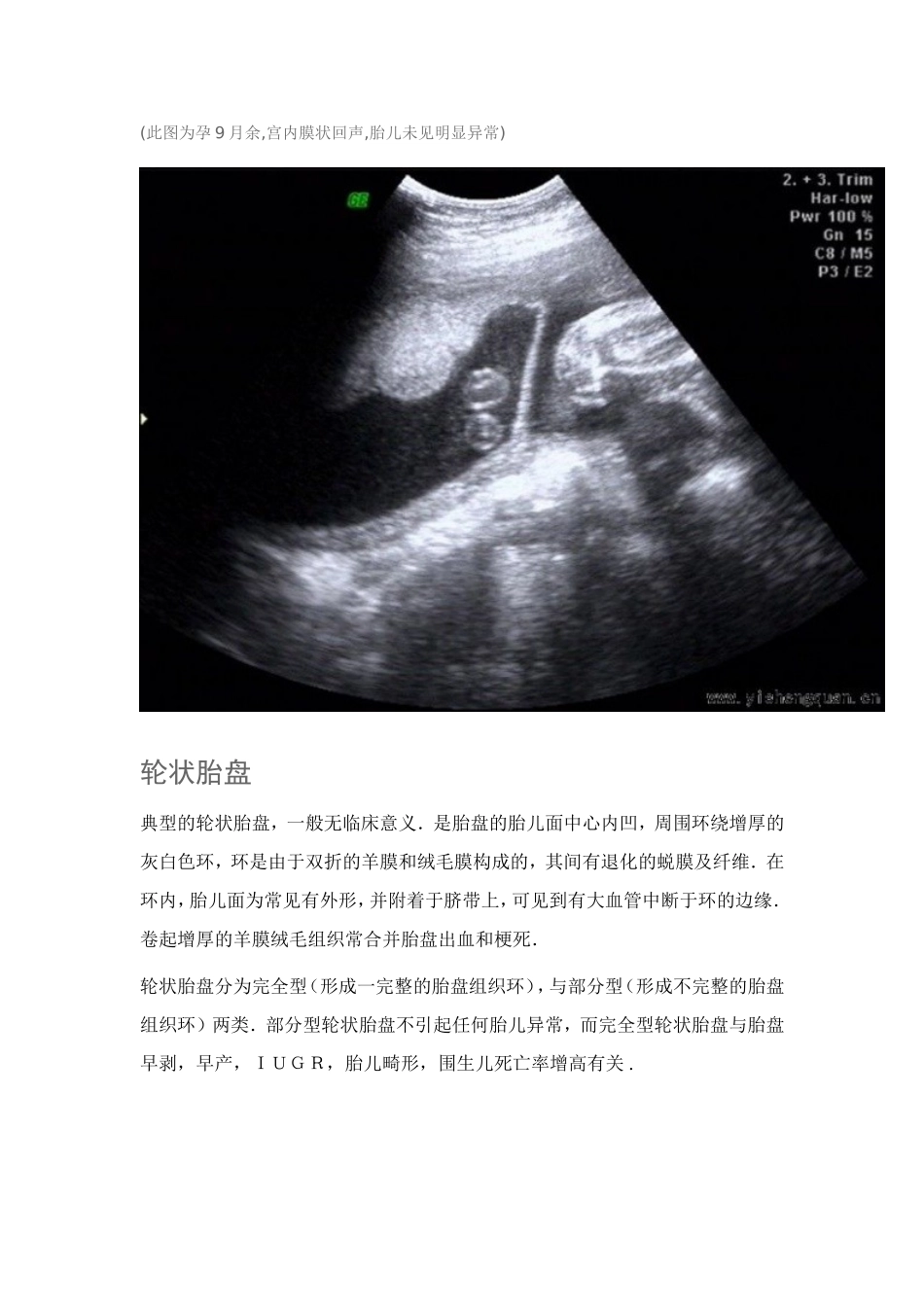 超声羊膜带 羊膜片_第3页