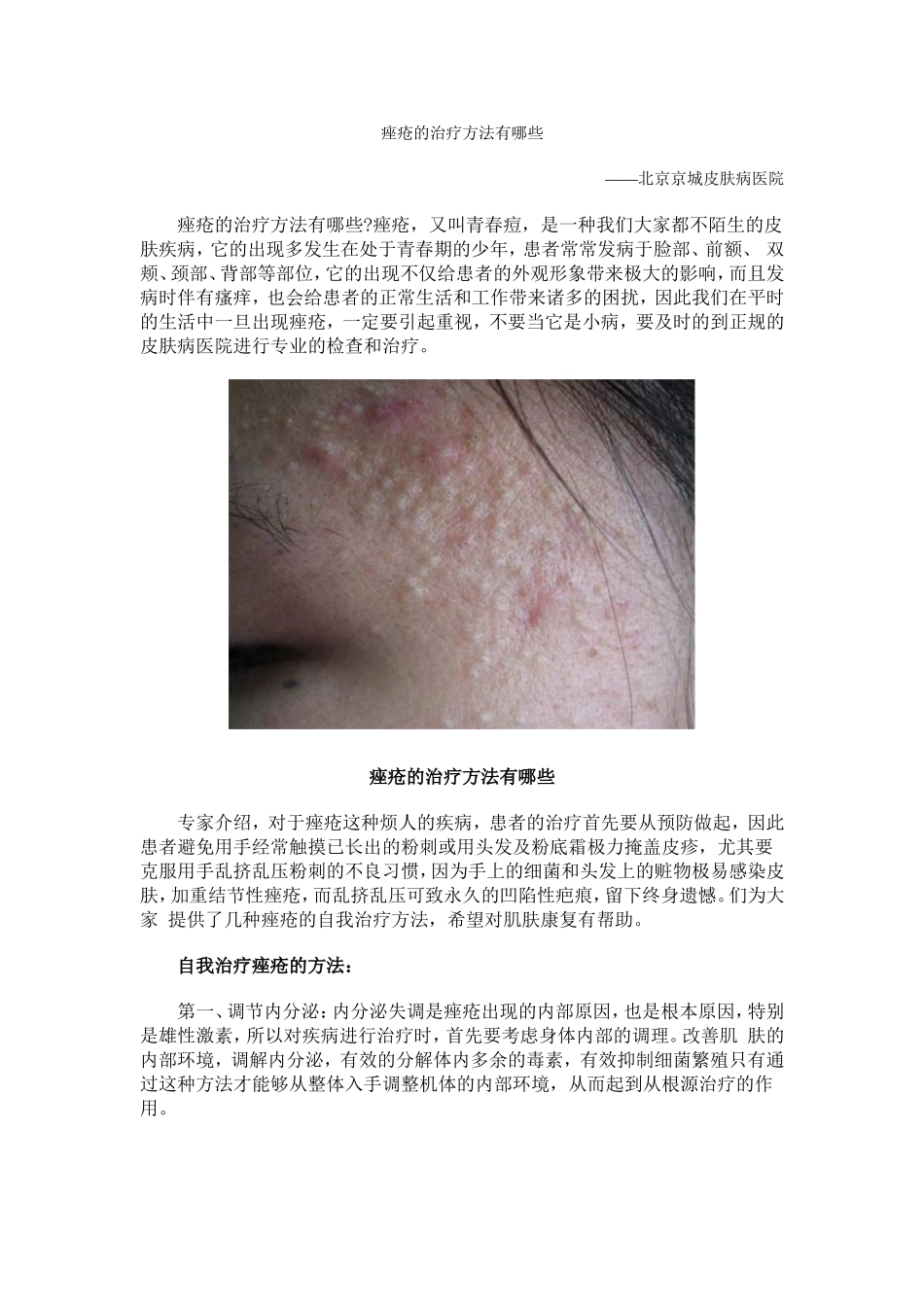 痤疮的治疗方法有哪些_第1页