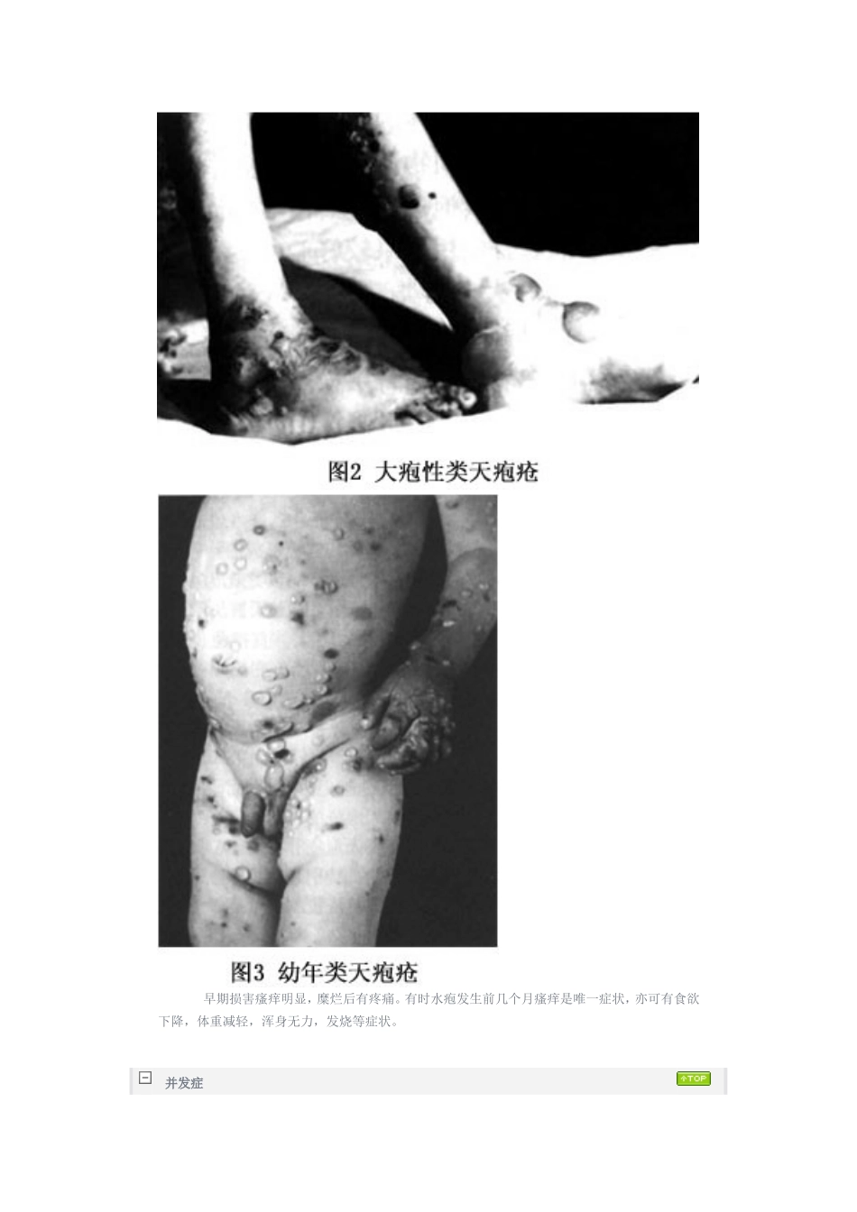 大疱类性天疱疮_第3页