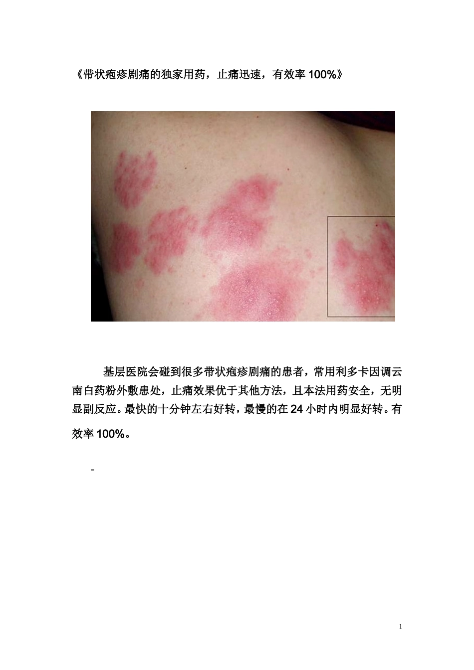 带状疱疹剧痛的独家用药_第1页