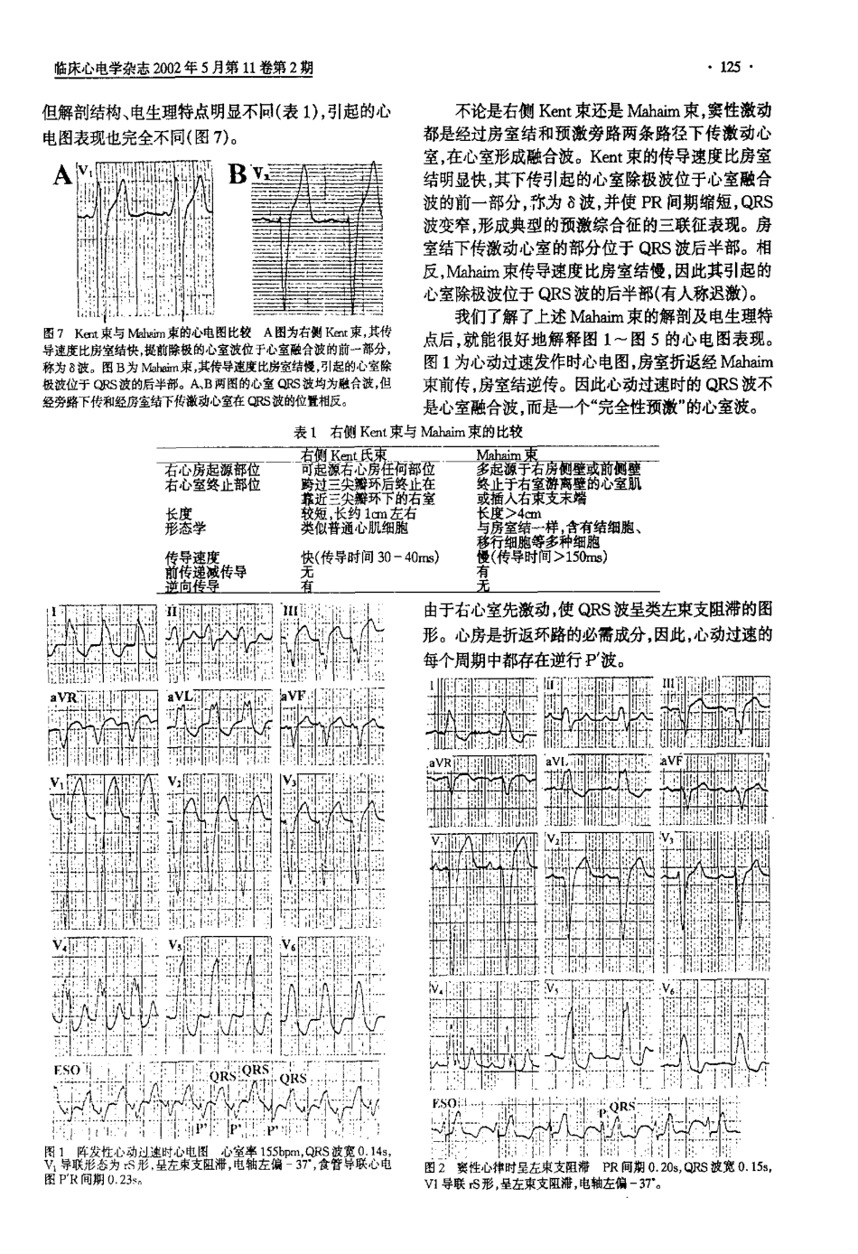 Mahim预激综合征的心电图特征_第2页
