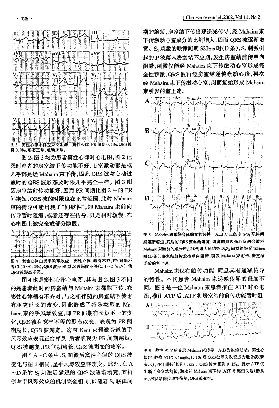 Mahim预激综合征的心电图特征_第3页