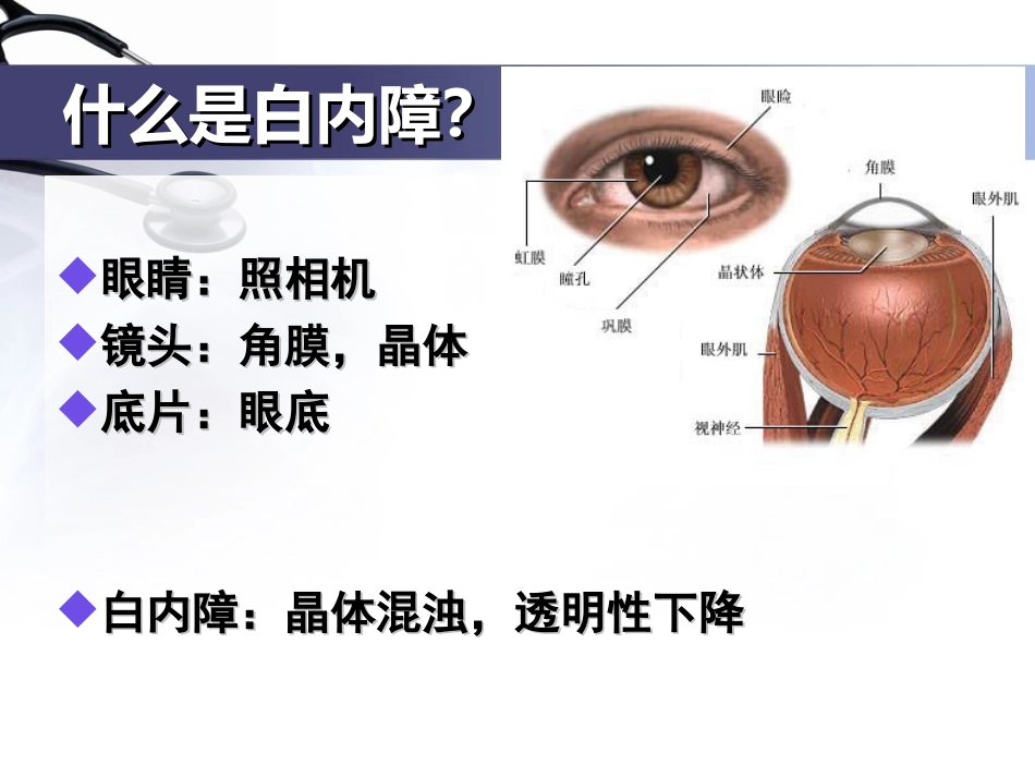 白内障的科普介绍_第2页