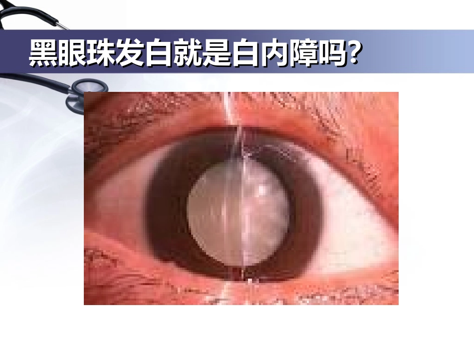 白内障的科普介绍_第3页