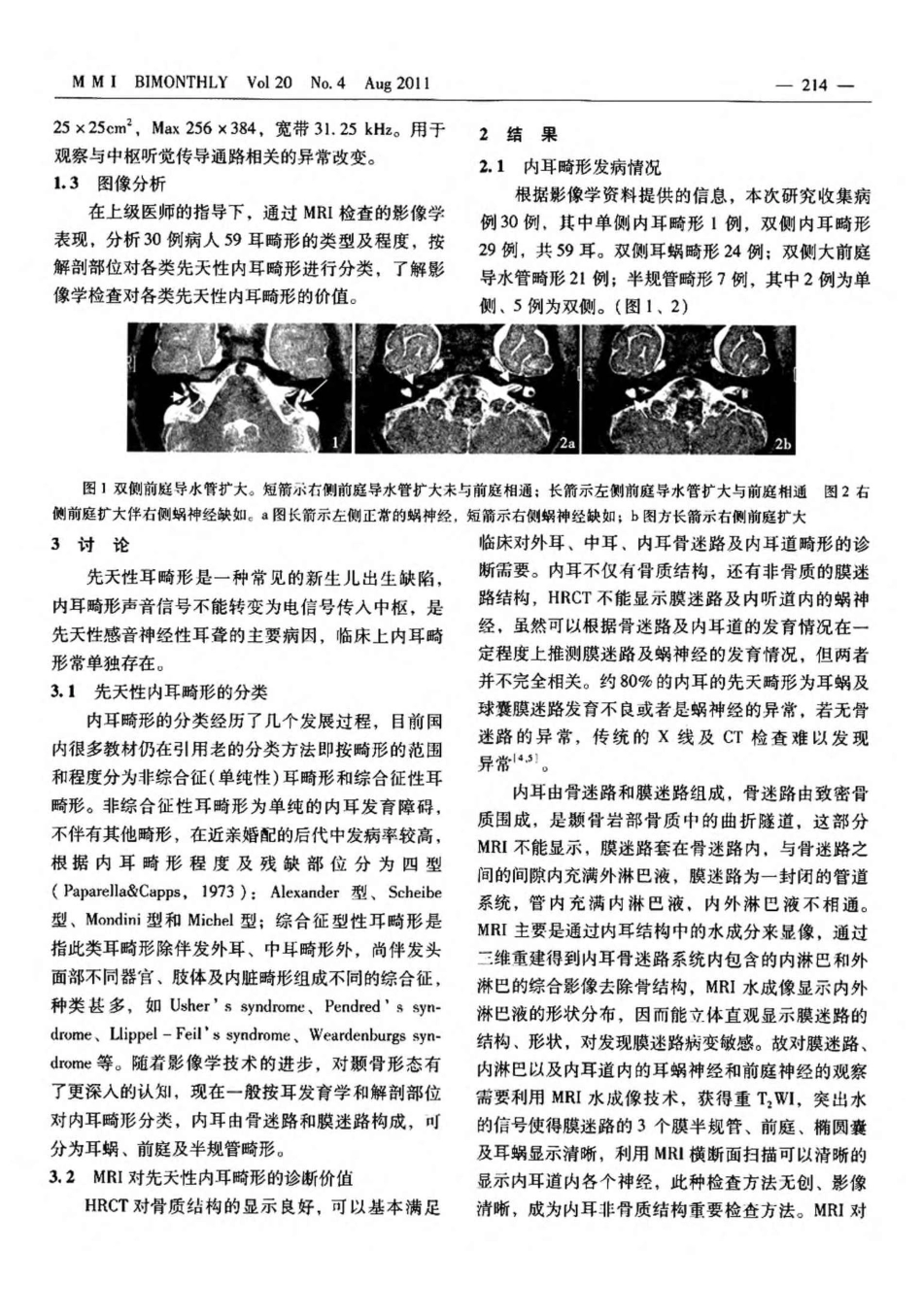 mri在诊断内耳畸形中的价值_第2页