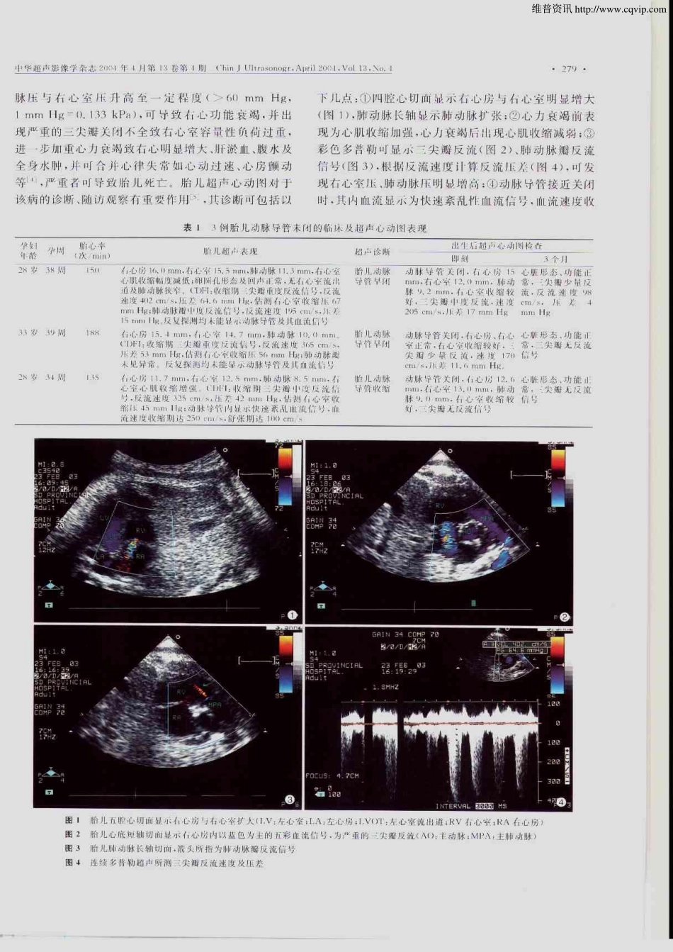 彩色多普勒超声诊断胎儿动脉导管早闭_第2页